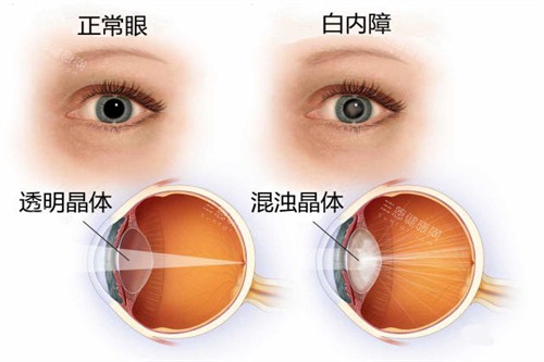 天津眼科醫院新價格表出爐！2026近視手術8800元起，青光眼/視網膜費用全公開！